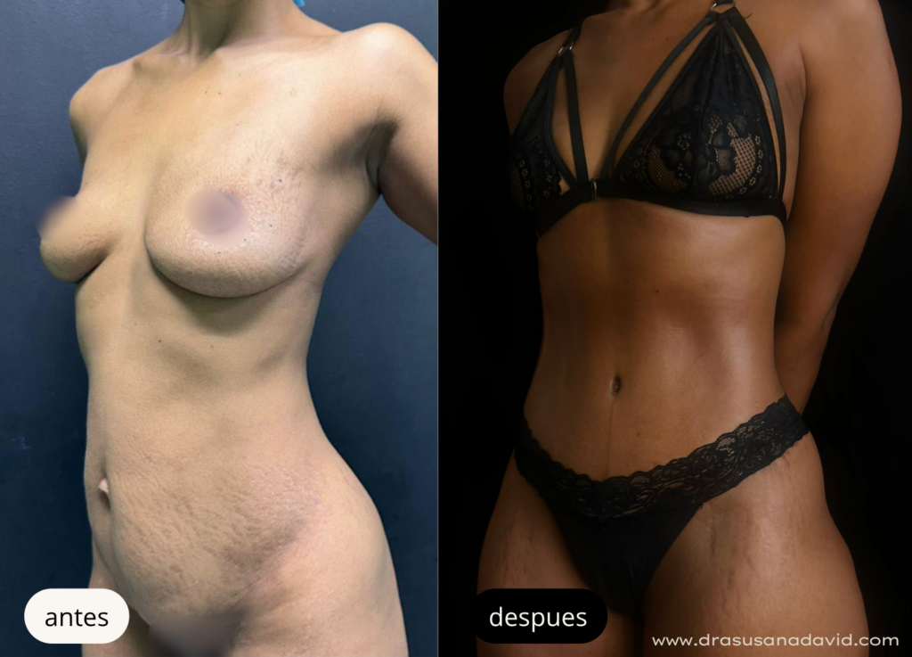 Antes y después de una abdominoplastia para eliminar exceso de piel y mejorar el contorno abdomin