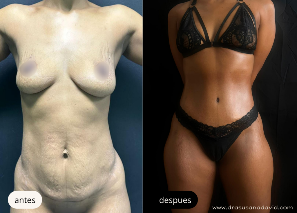 Antes y después de una abdominoplastia para eliminar exceso de piel y mejorar el contorno abdomin