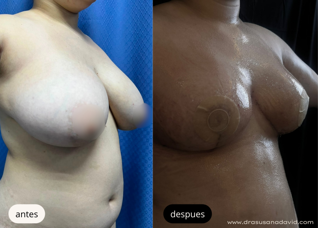 Antes y después de una reducción de senos para disminuir el volumen mamario y mejorar la comodidad de la paciente.