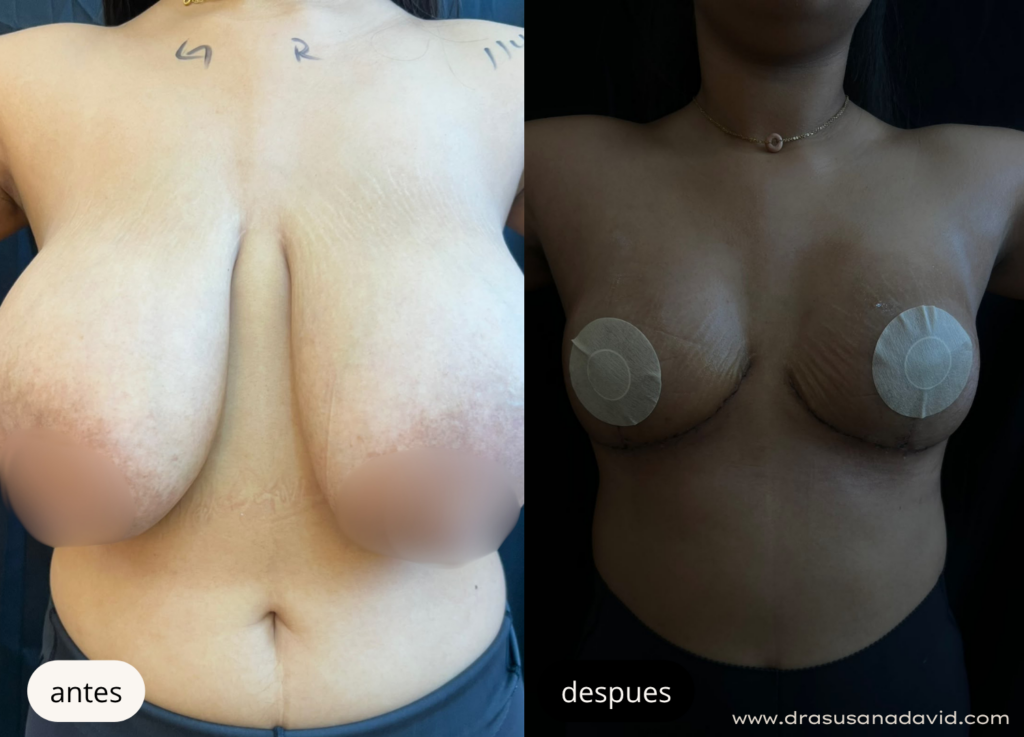 Antes y después de una reducción de senos para disminuir el volumen mamario y mejorar la comodidad de la paciente.